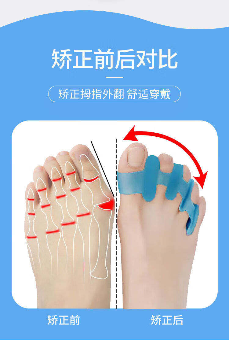 拇外翻脚趾重叠矫正分指器硅胶环舒缓效正矫形器儿童脚套穿鞋可用