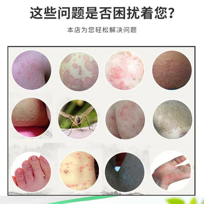 林旦乳膏30g阴虱男女私处外用软膏 买2 1