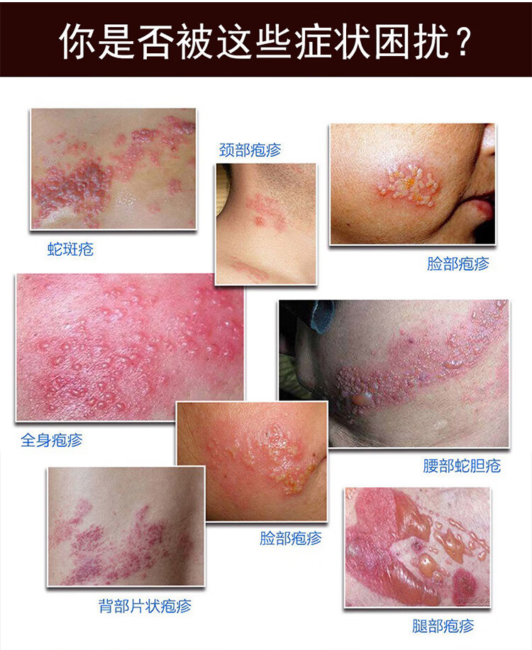 浅米草7号浅米草7号胡克蛇疼泡带状丹泡疹蛇缠腰蛇胆疮后遗症蛇盘七