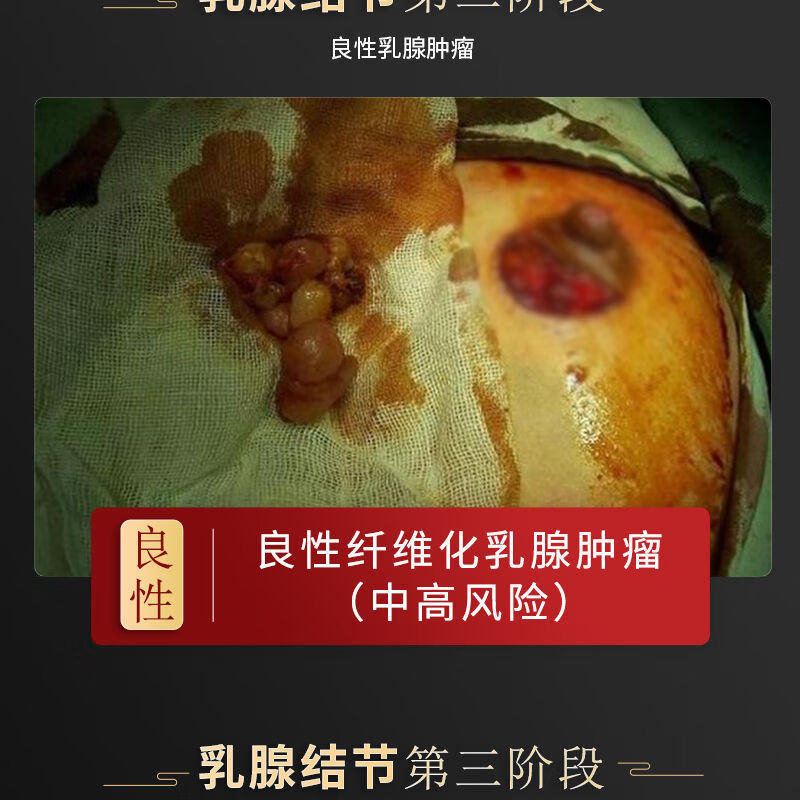 丸小叶乳房增生硬块肿块胀痛消结节奶结消散结蒲公英茶通 一罐(试用量