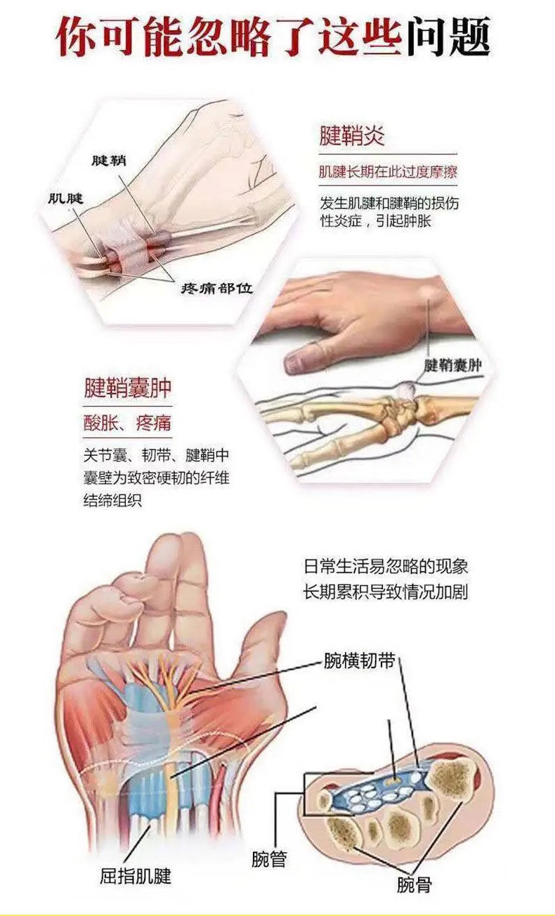 腕关节腱鞘炎解剖图图片