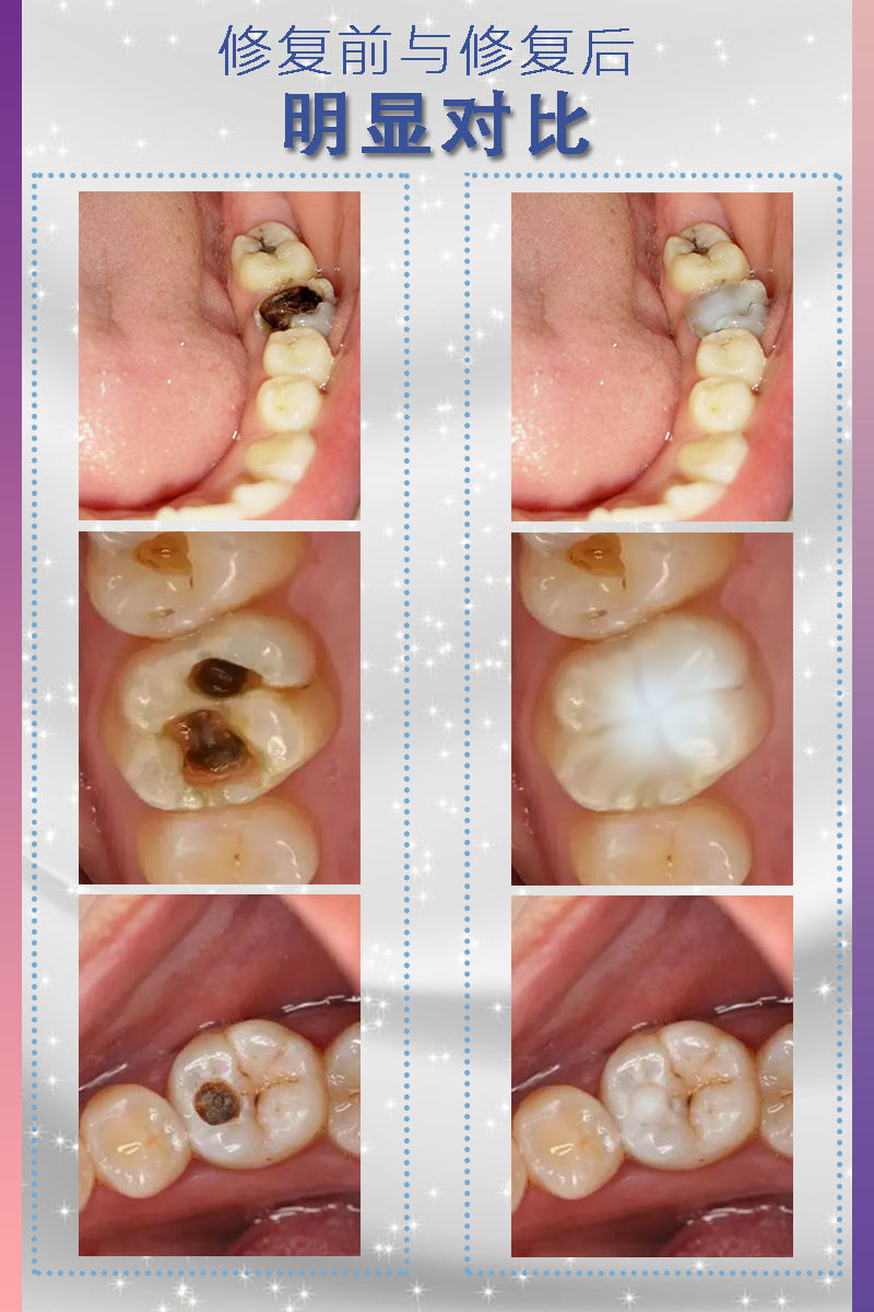 烤瓷牙粘合劑 自己補牙神器材料補牙縫填充補牙洞堵牙洞填充劑牙齒自