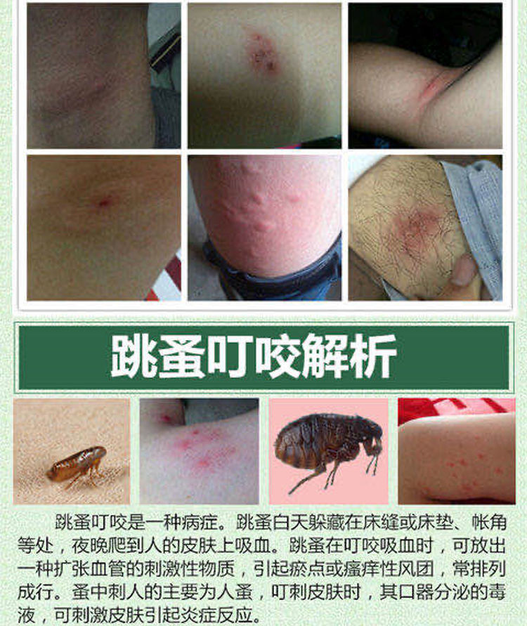 驱i蚊膏被毒虫红蚂蚁咬伤螨虫跳蚤蚊虫叮咬止痒皮肤瘙痒过敏消包紫草