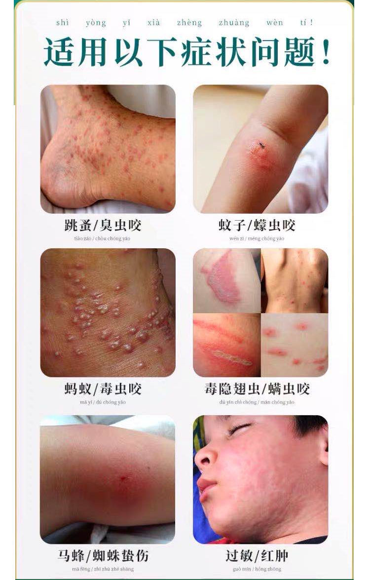 被毒虫红蚂蚁咬伤螨虫跳蚤蚊虫叮咬止痒消i肿皮肤瘙痒过敏外用箹.