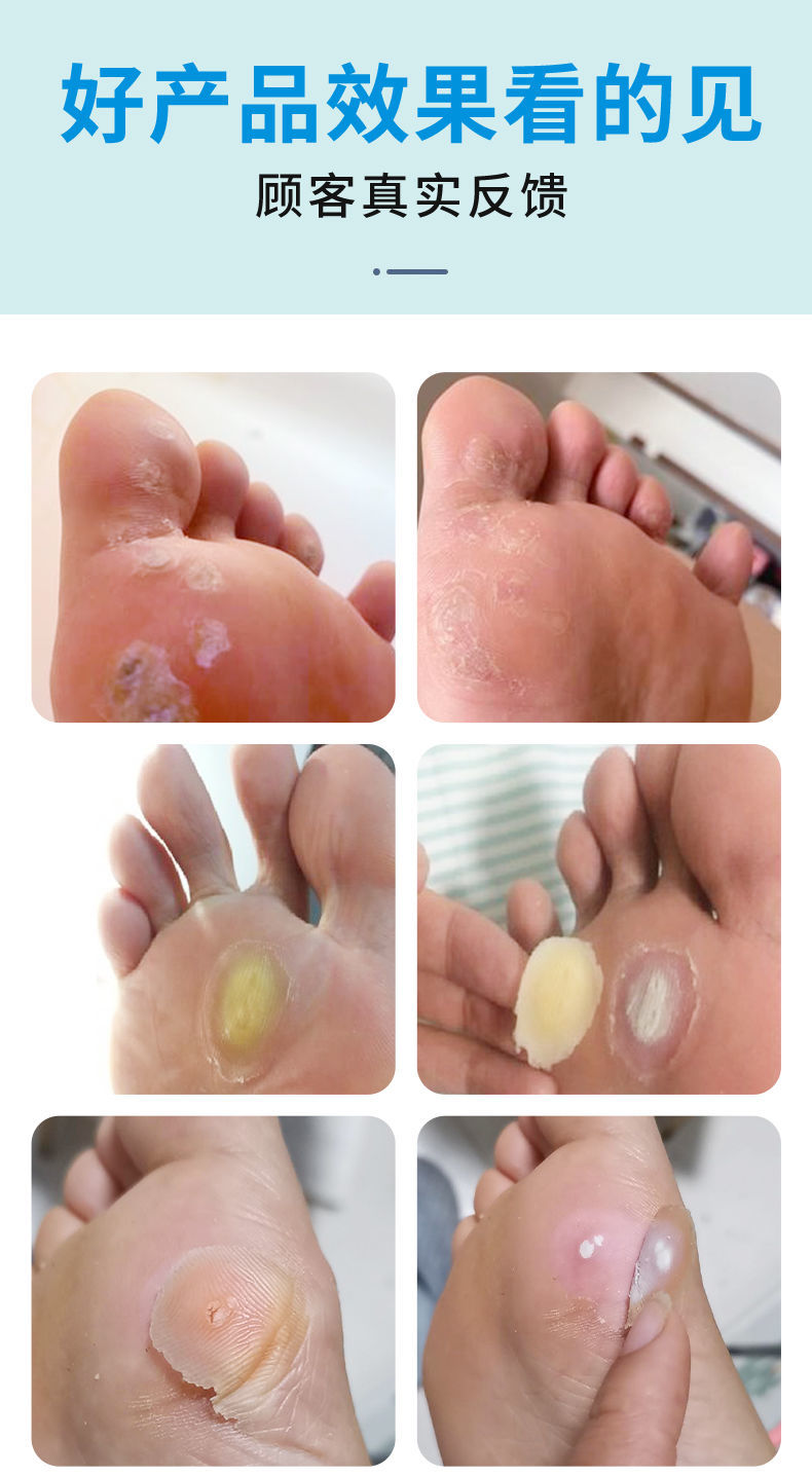 白云山鸡眼贴鸡眼膏贴肉刺老茧瘊子专用脚趾底死皮跖疣手足部鸡眼液6