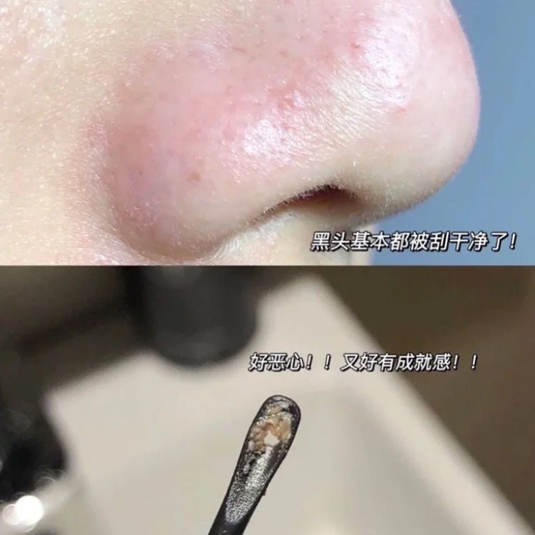 粉刺刮黑头双头棉签黑头导出液清洁掏耳朵挤痘棒30根祛黑头棉棒采耳