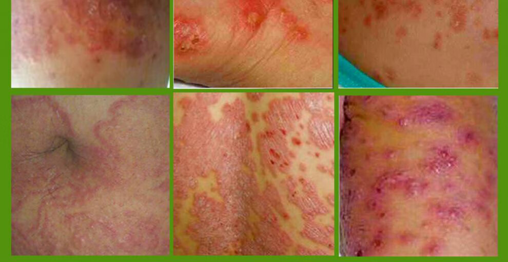 倍妙春藏宝皮独清乳膏皮毒清癣尼肤坤软膏祛湿痘