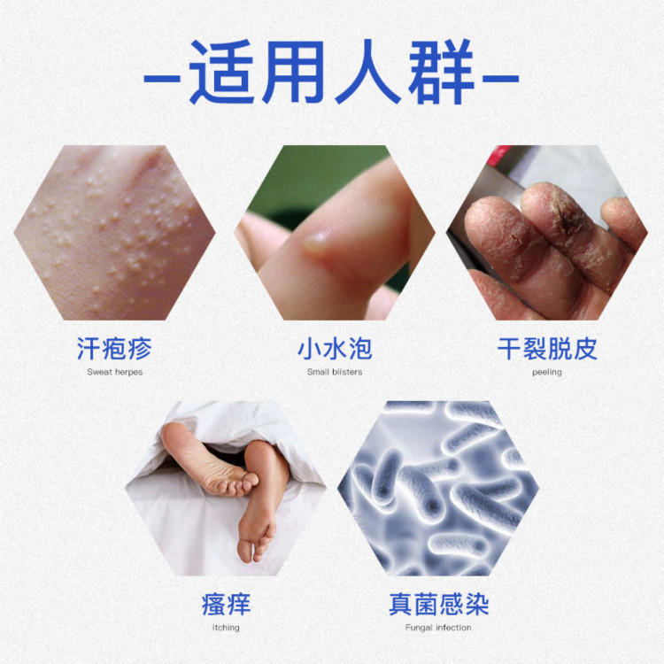 手气膏手痒手上干燥起皮小水泡止痒膏手气季节性手上起小水泡痒反复