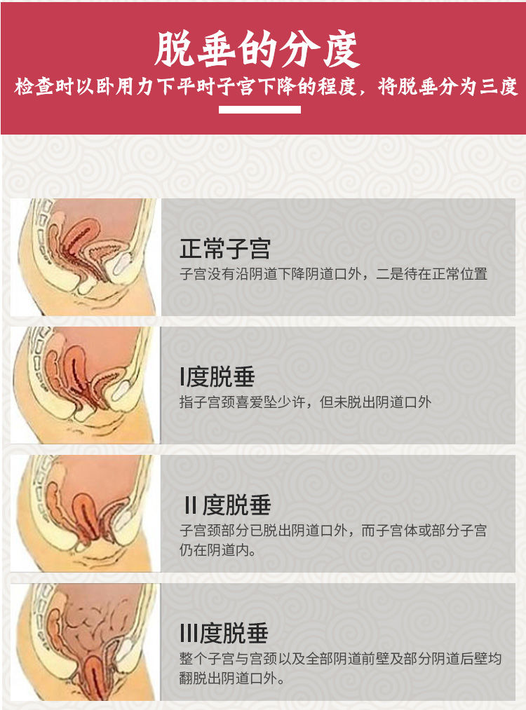 药店同款子宫下垂脱垂壁膨出提宫贴产后下垂老年脱垂提宫散肚脐贴10贴