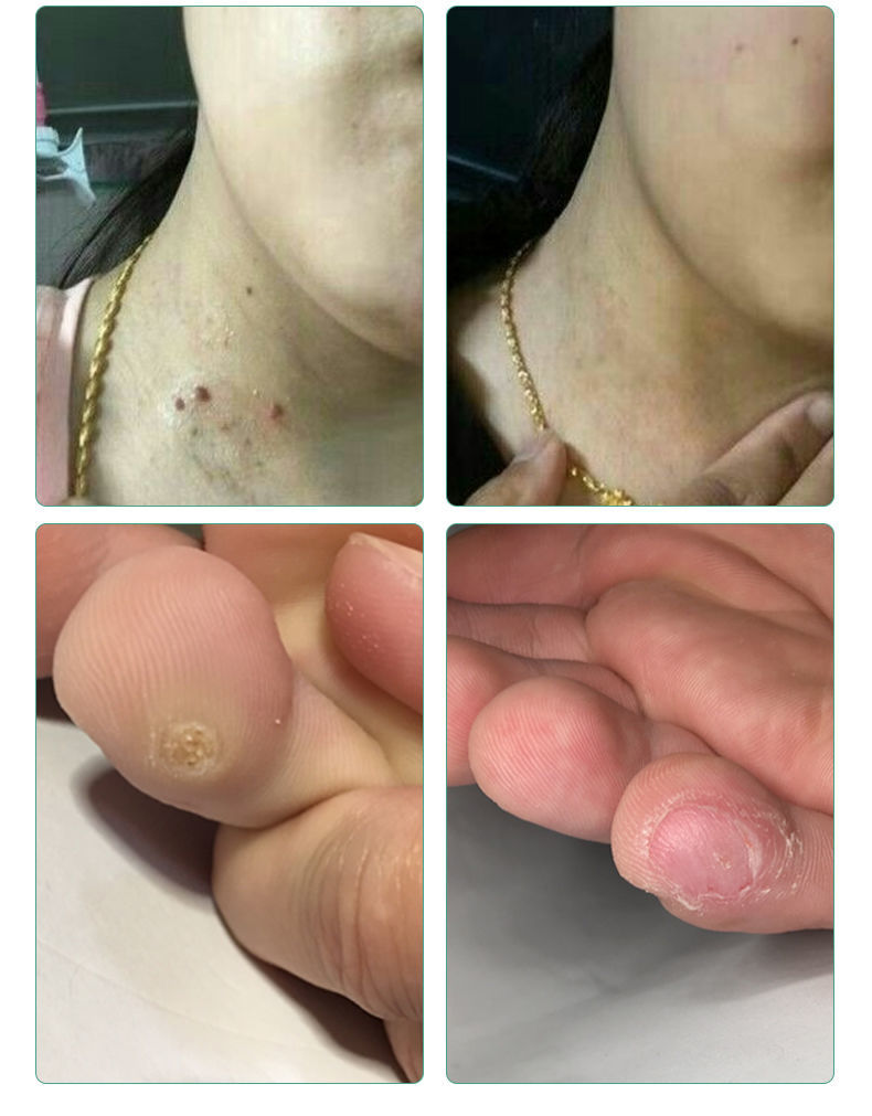 青原山力克宁去除脖子小肉粒赘皮扁平尤祛1疣瘊丝状尤腋下小猴子