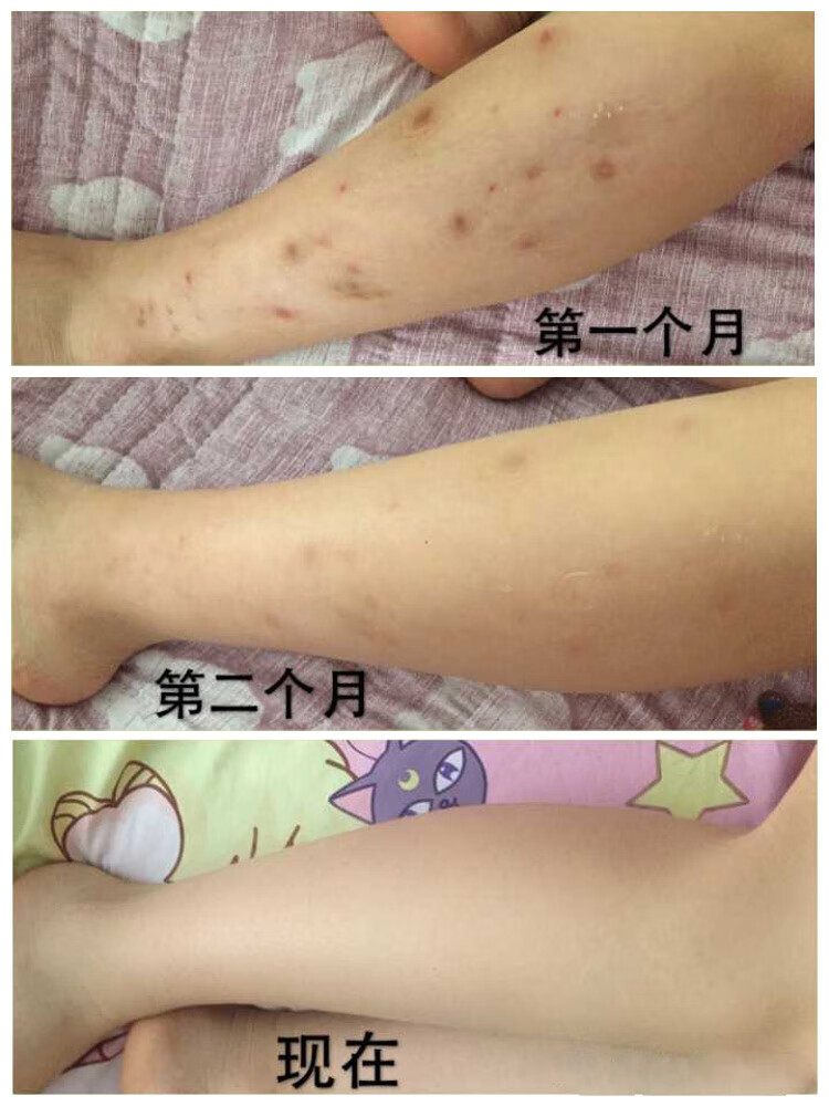 去蚊子叮咬疤印淡化疤痕沉淀印膏祛腿上印修复痕迹