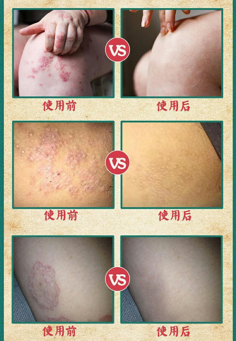 复方黄柏癣祛搽剂初肤堂同款癖祛喷剂牛皮鲜癣屑银病组合套装 买1
