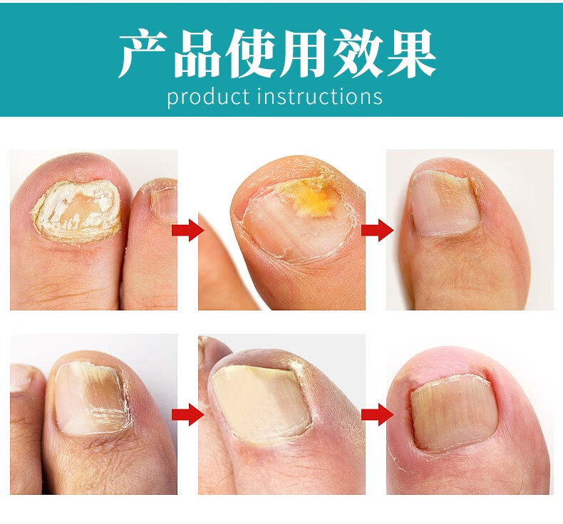 灰甲剪刀水甲沟炎专用灰甲净水液灰甲清仙蒂蕾拉1盒装12个指甲默认1