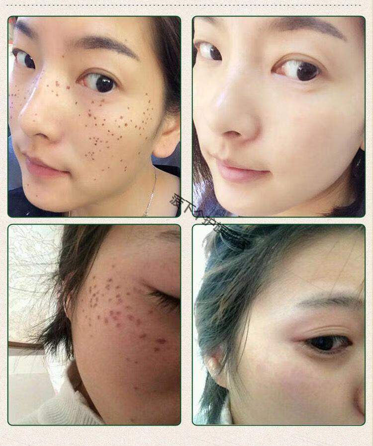 点痣药水无痕去痣笔黑痣祛痣斑水祛痣膏产品脸部家用雀斑强烈2瓶修复