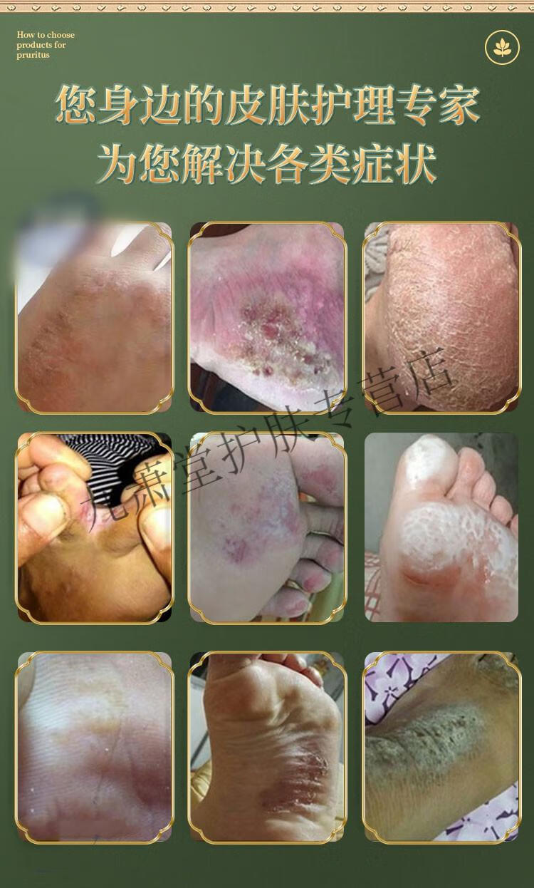 官方庐城庐江马厂美康霜皮肤痒湿痒红点蚊虫叮咬臭脚丫腿内侧潮湿手足
