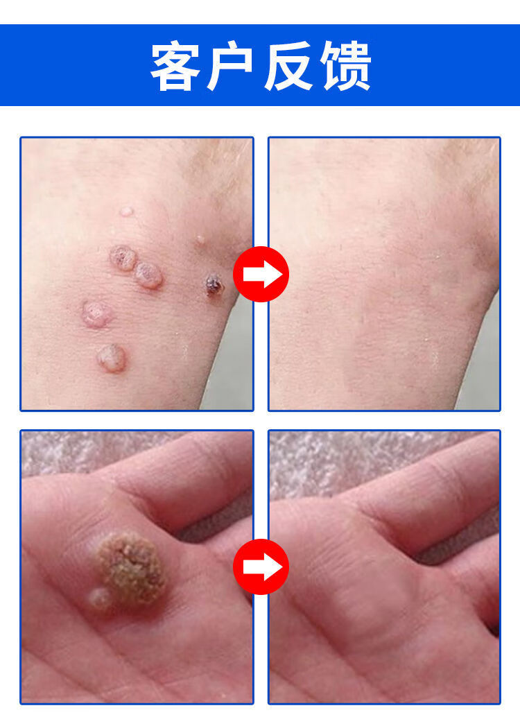 祛i疣灵l扁平丝状i疣脖子猴子克i疣膏祛i疣净 疣i必清尤疣克舒软膏