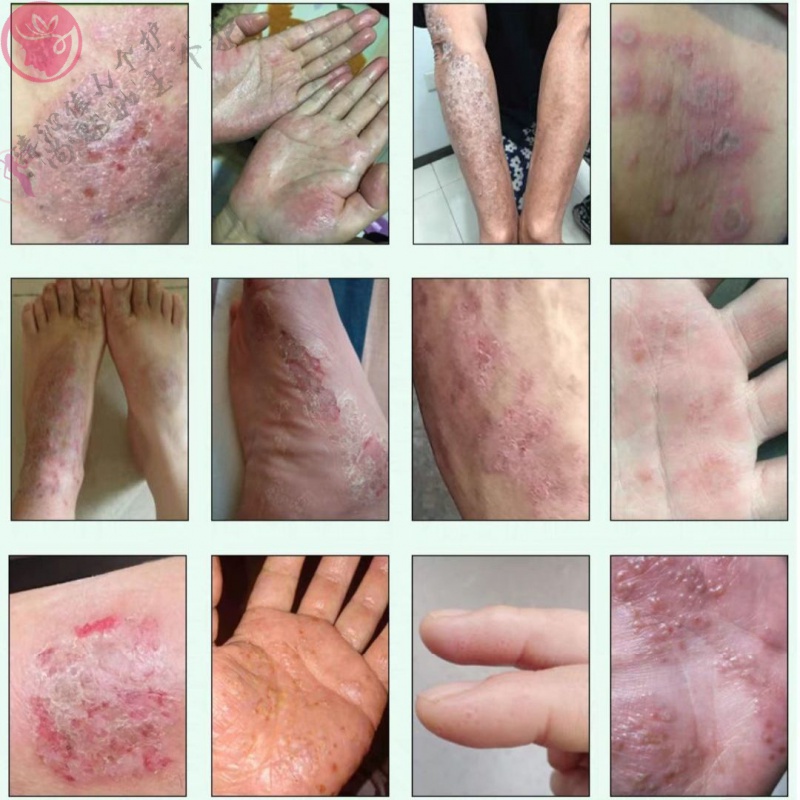 【官方旗舰】京康恩手上小水泡脱皮皮肤痒干燥脱屑起