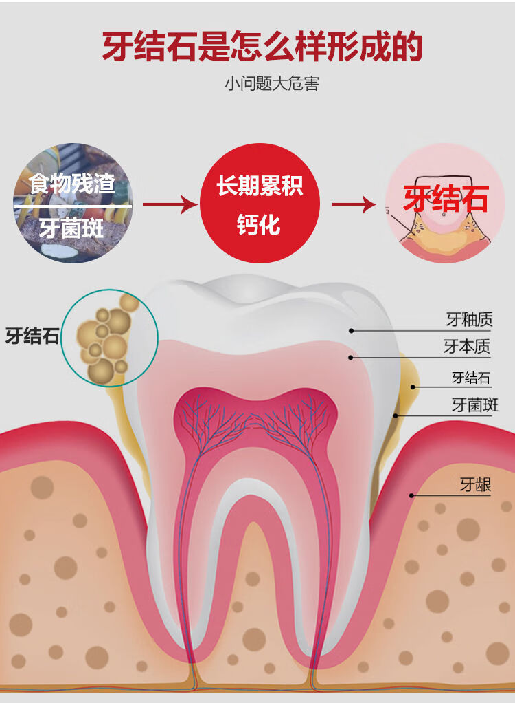 牙结石图片形成原因图片