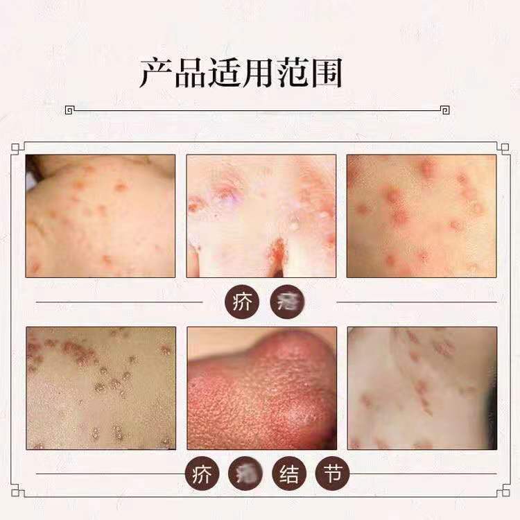 硫磺软膏20%百分之二十浓度【严重专用】男女老人可用硫磺软膏 5支装