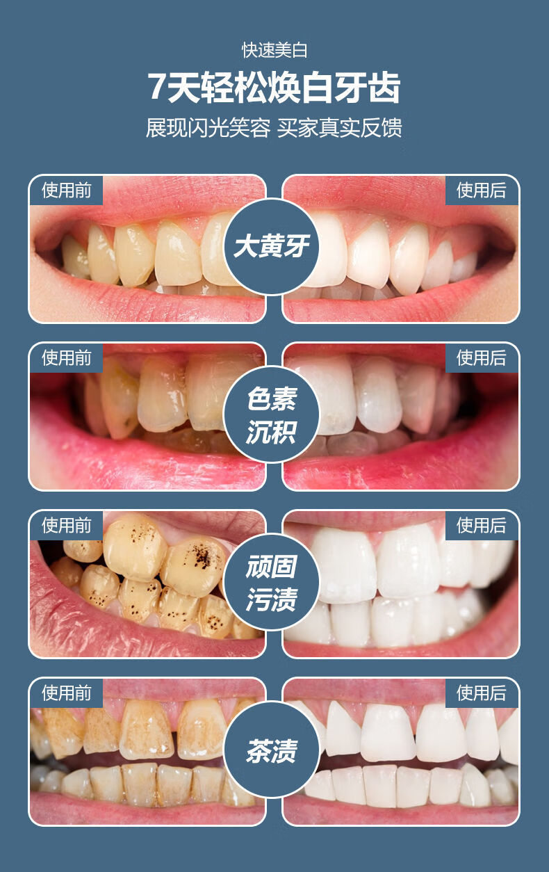 牙貼潔白清潔牙齒李佳琦同款煙漬茶漬牙貼片5d四盒裝鞏固