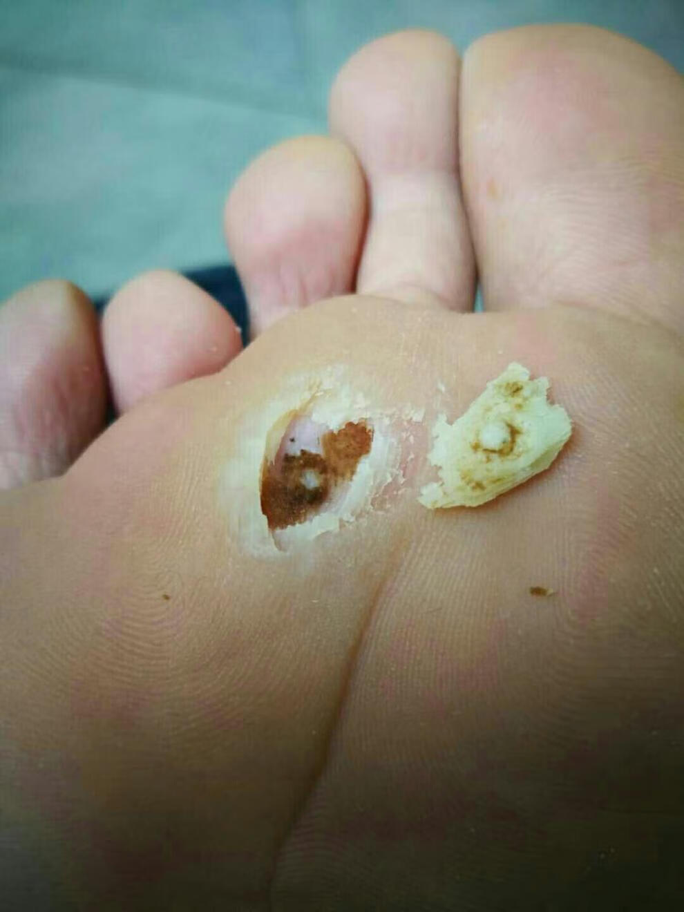 【京健康】刺去除膏跖疣神器血泡刺药去修子鱼鳞痣贴休子猴子瘊子点