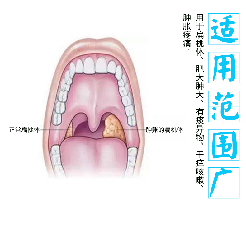 喉咙有异物喷扁桃体发i炎肥大肿大咽喉肿痛干痒喉咙有痰异物感咳嗽