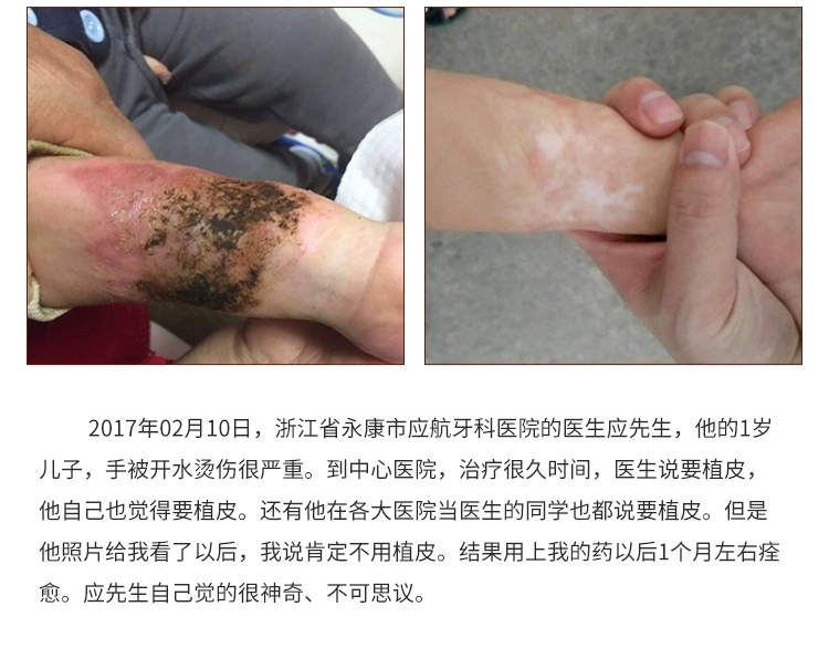 糖尿病足爛腳脈管炎生肌膏老爛腿靜脈曲張潰爛止痛外用藥癒合傷口白色