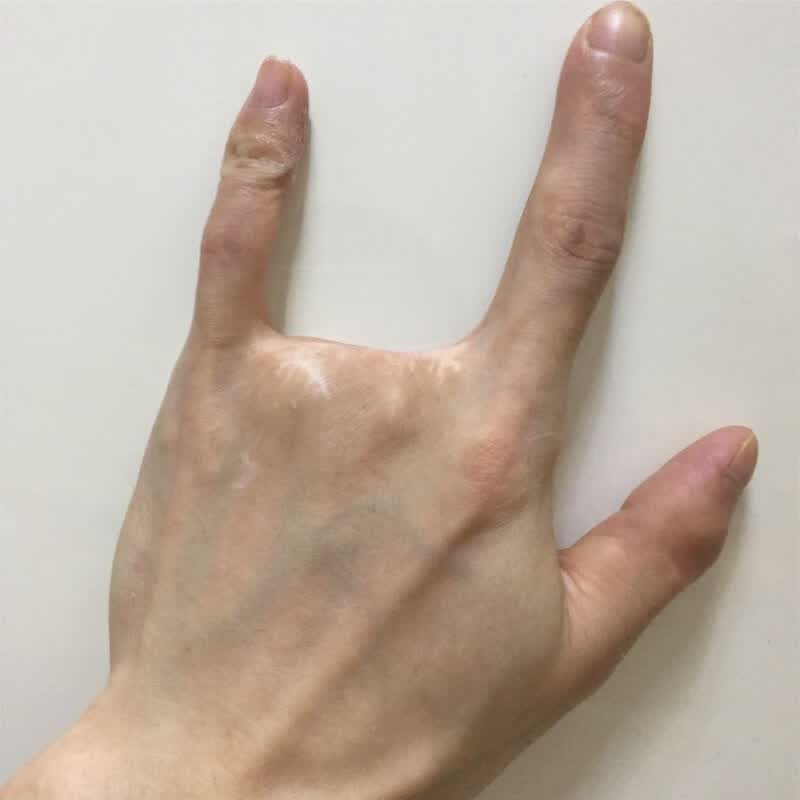 定制假肢手头指假指手头仿手断手美容手掌指头量身定做假脚趾假指头