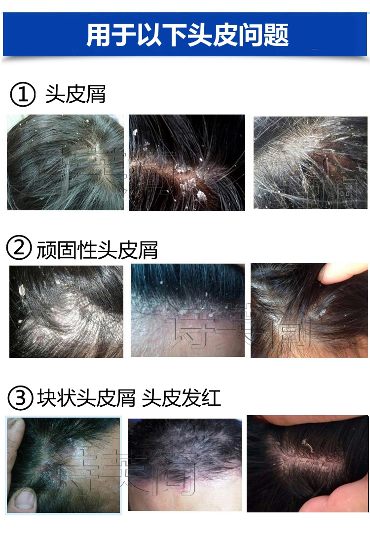 癣屑头皮鲜藓头皮屑清理去头屑严重的箹去屑除螨癣治头痒止痒洗发水