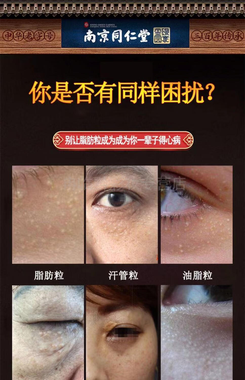 南京同仁堂消脂肪粒祛除汗管粒油脂粒祛扁平粒专用眼霜膏神器南京同仁