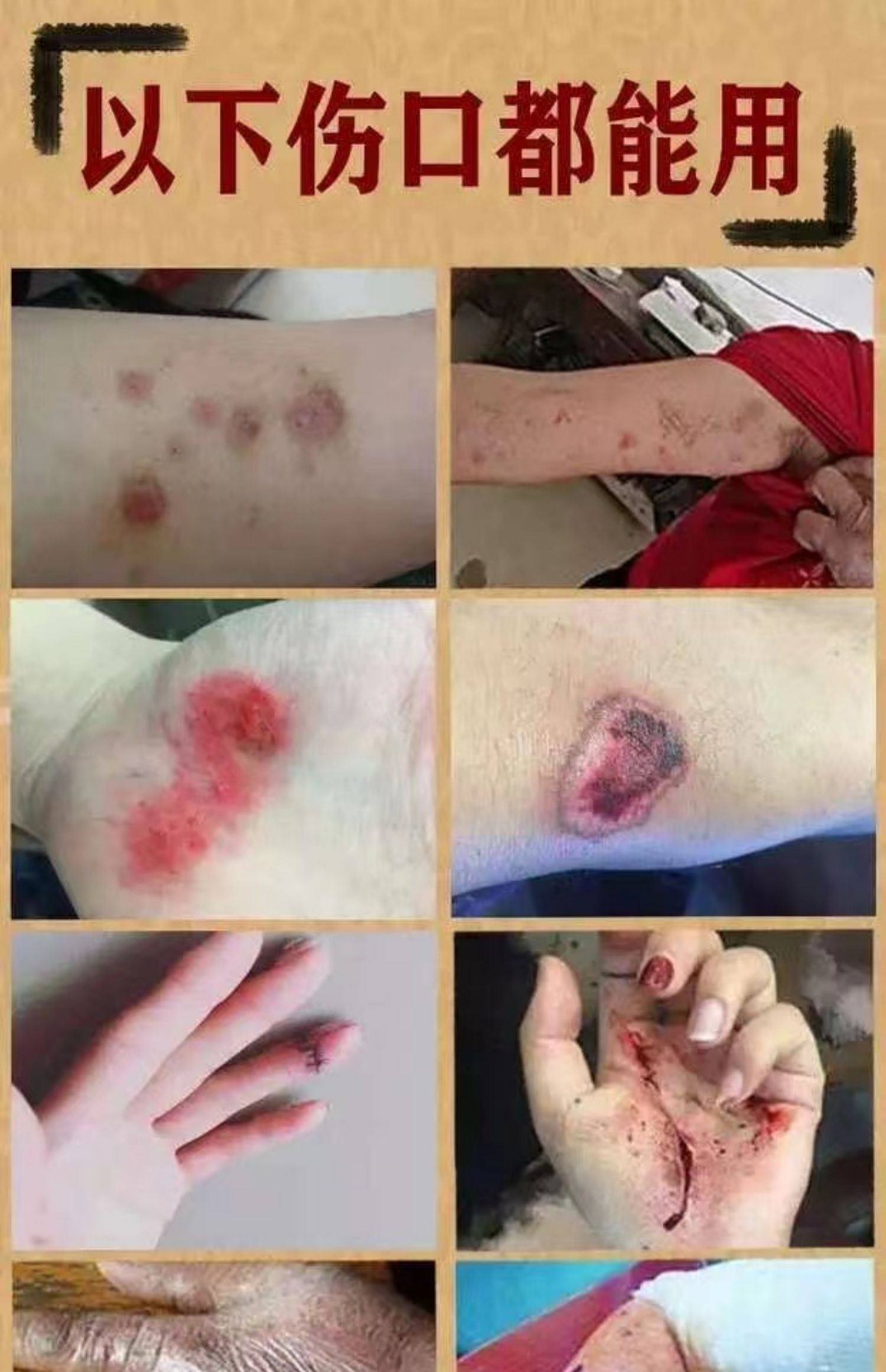 褥疮膏老人臀部外用伤口愈合屁股去腐愈皮生肌膏老烂腿压疮白色