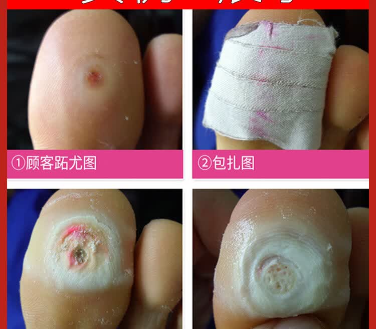 跖疣膏修脚店专用手足部肉刺猴子趾疣老茧无痛膏贴疣瘊净 白色【图片