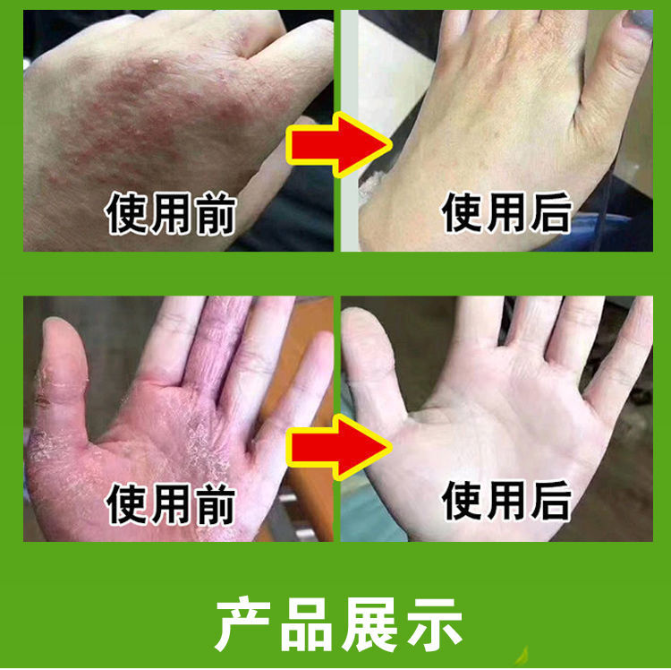 清肤柏可芬软膏湿ii疹止痒皮ii炎大腿手部湿ii疹荨ii麻ii疹毛囊炎皮肤