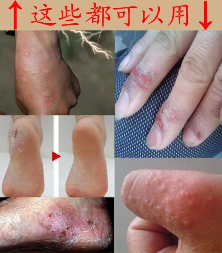 鹅掌风手癣膏手足癣汗疱疹湿疹止痒去根干裂脱皮真菌感染专用药膏 染