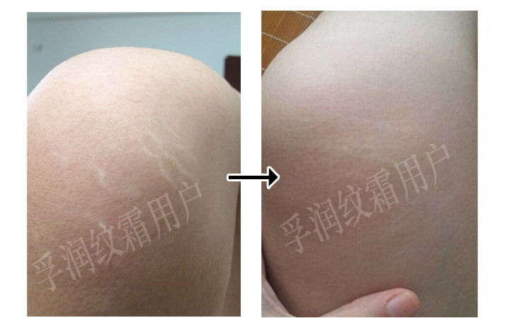 你尊 肥胖纹修复霜消除去肥胖纹生长纹消除大腿学生淡化祛除紧致 买2