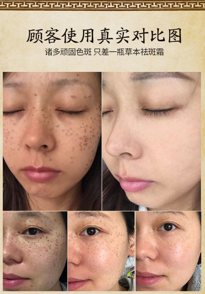 氢醌霜乳膏淡化分解i黑色素【官方】男女霜雀斑晒斑老人斑亮肤点 2f2f