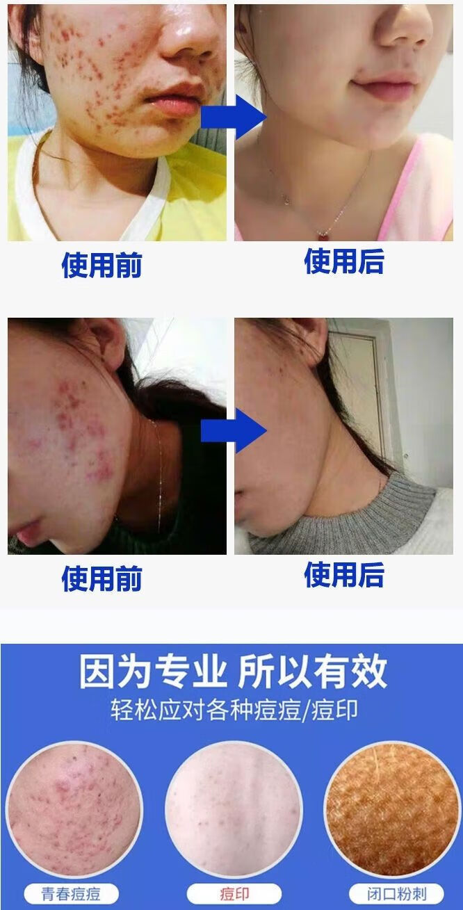 伊芝清浅姿兰】香港祛.痘膏祛痘印淡化痘印青春痘闭口粉刺去痘学生祛痘 祛痘洗面奶一支