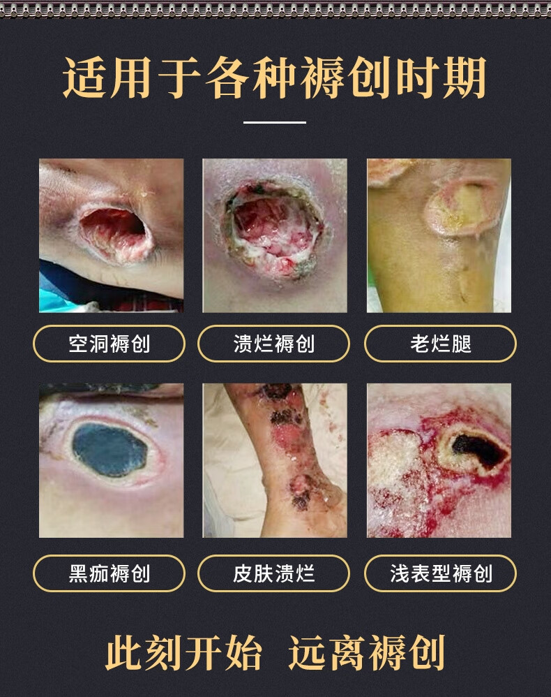 褥疮膏压疮膏汉方生肌膏烧膏卧床老人臀部伤口愈合老烂腿外用