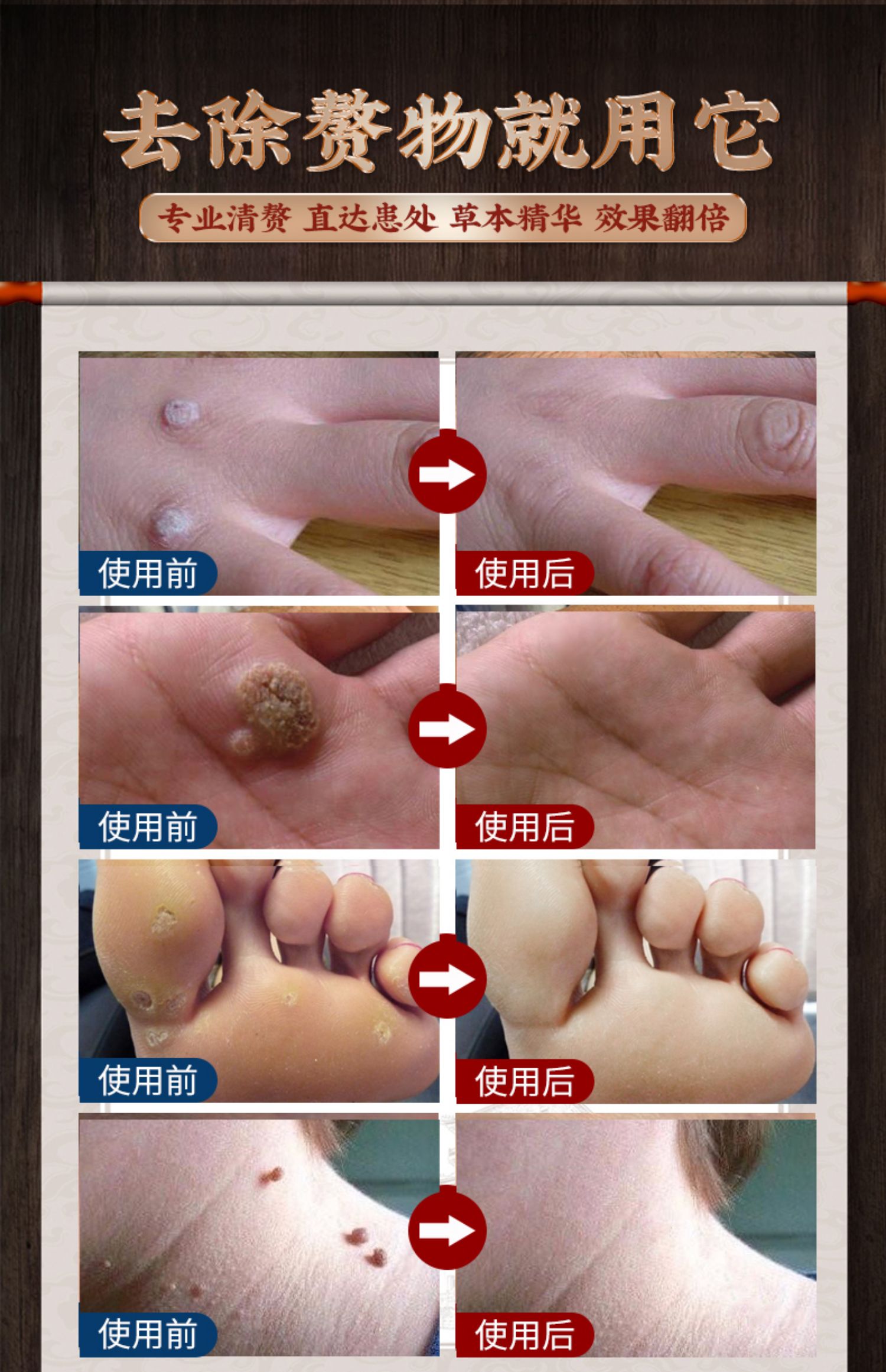 【官方旗舰】瘊优偏方膏氟尿i嘧啶乳膏疣清宁南京同仁堂扁平i疣瘊偏方