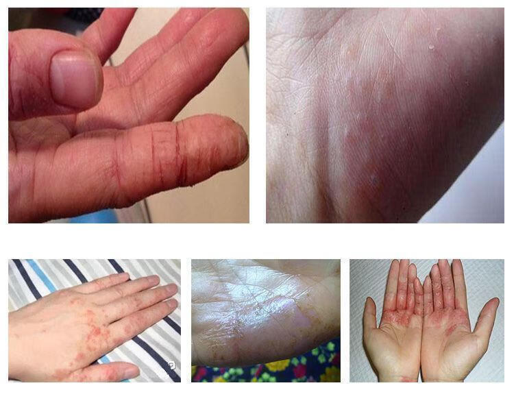 尼坤拓实膏软膏起水泡止痒草本手痒脱皮泡诊湿诊1支装喷剂