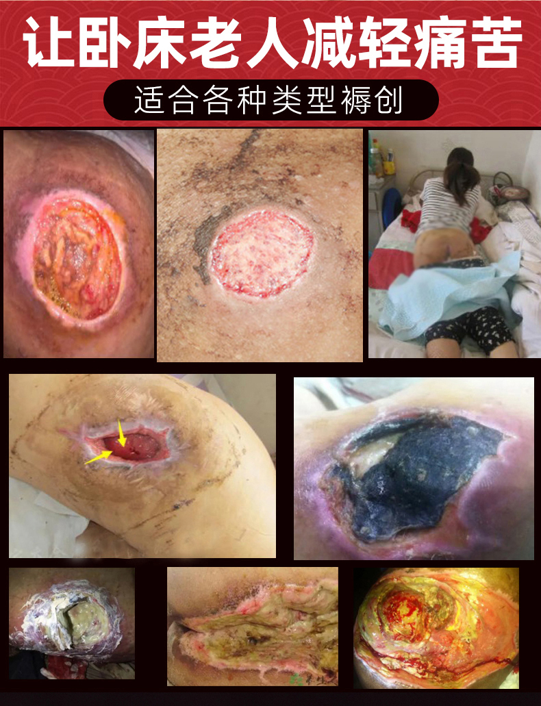 褥瘡膏生肌膏空洞黒痂傷口去腐生肌老人臥床臀部壓瘡禾一堂褐色