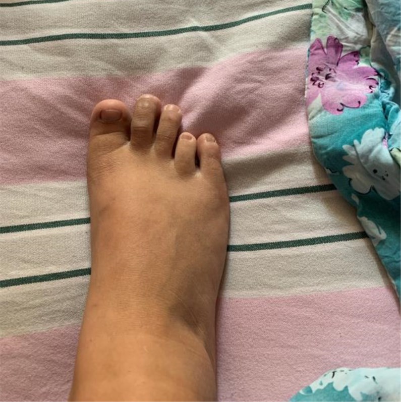 定制假肢手头指假指手头仿手断手美容手掌指头量身定做假脚趾假指头大