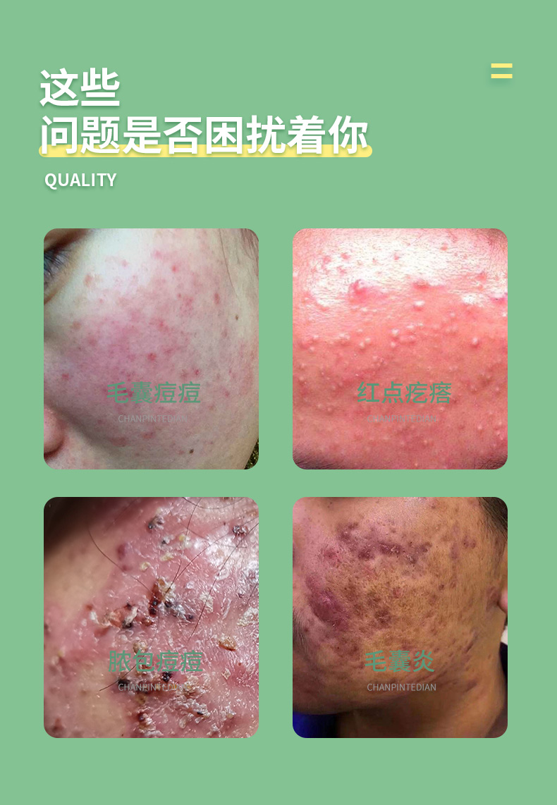 赞克阿赞多c型中草本膏官方链接专攻毛囊痘啊赞多c型中重度两盒装