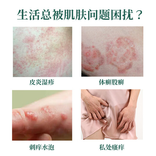 Chunchuntang Yunnan Herbal Eczema Cream for adults to relieve itching skin, scrotum, moist itching, inner thigh, anus and private parts for men. Buy 1 get 1 free. 2 bottles sent. Double effect combination.
