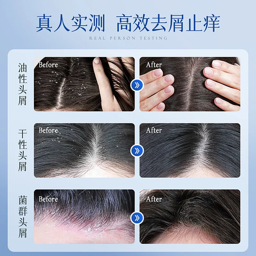 VITEER Sélénium Disulfure Shampooing for Men and Women Anti-Dandruff Anti-ICH Control Control durable durable durable shampooing rosée Gold List n ° 1 Prigrance restante [Formule de recherche médicale] 95% du choix des clients