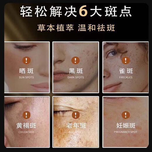Peking Tongrentang Sommersprosse-Entfernungscreme Nr. 1 Starkes Aufhellung und Aufhellen des älteren gelben, bräunten, sonnengetrockneten Sommersprossen Melanin Feuchtes Gesicht echtem Astragalus für Männer und Frauen. 1 Flasche wird empfohlen, um 50 g gemäß dem Behandlungsverlauf zu verwenden