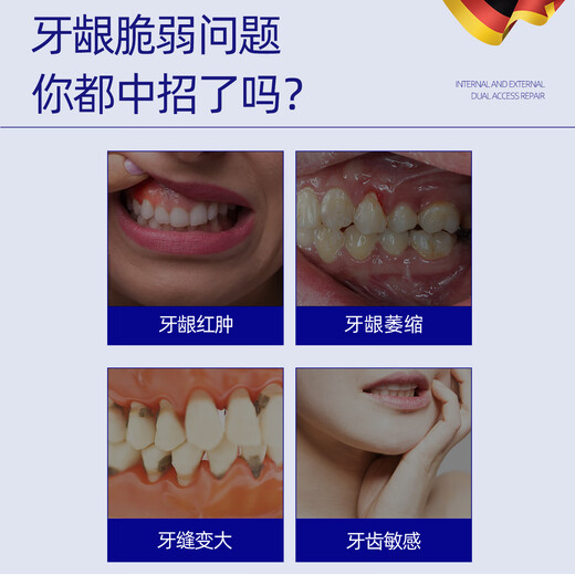 Warronson Medical Medical Tooth Pasta Gingival Atrofia Protección de protección de las encías especiales para los dientes sueltos y la fijación del diente Periodontitis Periodización severa antiinflamatoria Hinchazón y reparación del dolor Regeneración de la eliminación de incendios Protección de alivio de alivio Grado 3 Cajas de Grado 3