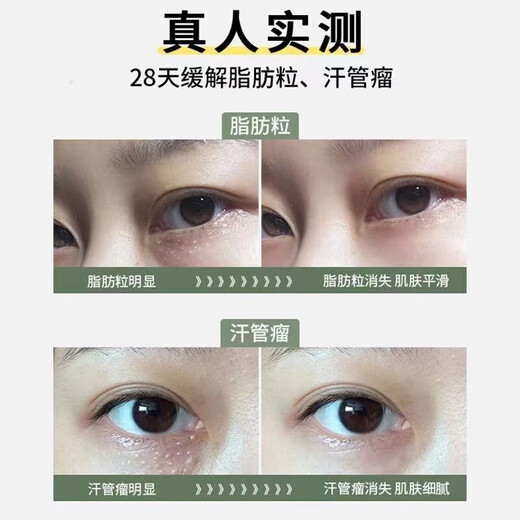 Sweat mandibular tumor removal cream fat particles removal tool oil particles removal white particles for men and women's eyes special eye cream in one box