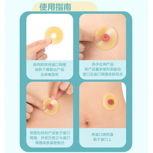 
Ostomy leak-proof ring plastic patch ring 12030 chassis leak-proof patch elastic glue 1 box/10 pcs M12042 leak-proof patch ring (4mm thick)