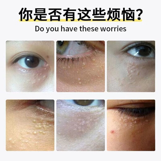 Sweat mandibular tumor removal cream fat particles removal tool oil particles removal white particles for men and women's eyes special eye cream in one box